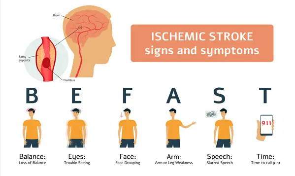 What are three signs of ischemic stroke?