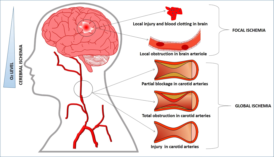 triggers an ischemic stroke