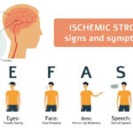 What are three signs of ischemic stroke?