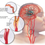 causes of a stroke