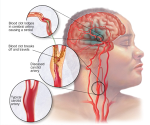 causes of a stroke