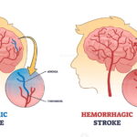 difference between a stroke and an ischemic stroke