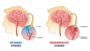 difference between a stroke and an ischemic stroke