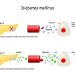 life expectancy of a diabetic Type 2 female