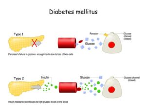 life expectancy of a diabetic Type 2 female