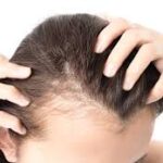 major causes of hair loss