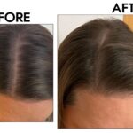 regrow hair after thinning