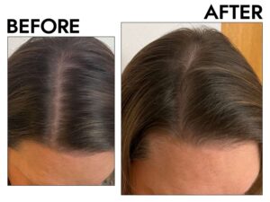 regrow hair after thinning